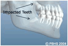 Wisdom Teeth Removal Illustration